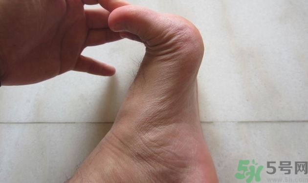 腳拇指外翻遺傳嗎？腳拇指外翻怎么矯正？