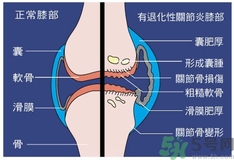 骨關(guān)節(jié)炎能治好嗎？骨關(guān)節(jié)炎平時(shí)注意事項(xiàng)