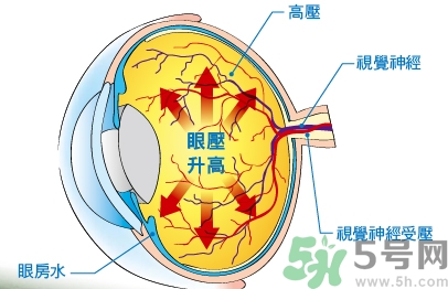 青光眼可以治愈嗎？青光眼怎樣治療？