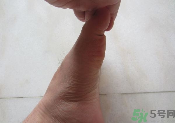 腳拇指外翻遺傳嗎？腳拇指外翻怎么矯正？