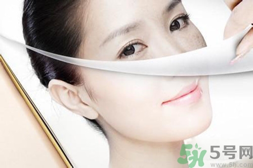 曬斑可以自己消退嗎？曬斑可以用激光去除嗎？