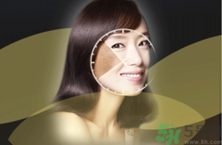 曬斑可以自己消退嗎？曬斑可以用激光去除嗎？