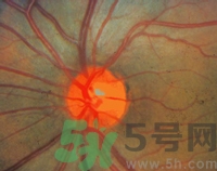 青光眼可以治愈嗎？青光眼怎樣治療？