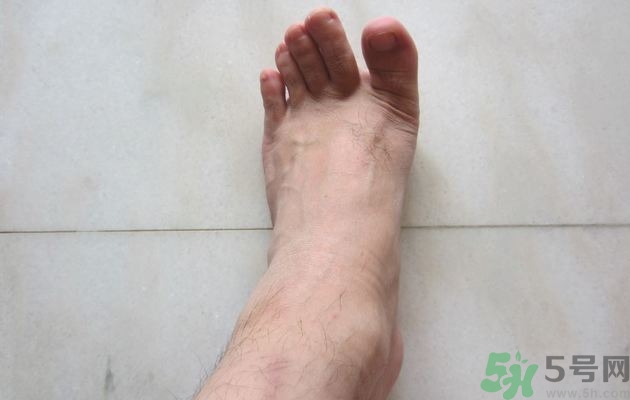 腳拇指外翻遺傳嗎？腳拇指外翻怎么矯正？