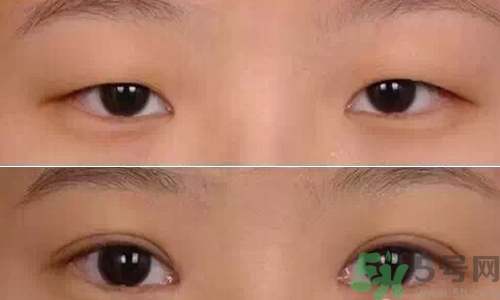 天生腫眼泡怎么消除？天生腫眼泡怎么辦？