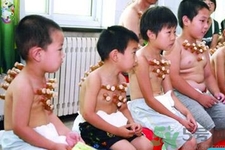 小孩可以拔罐嗎？寶寶能拔火罐嗎？