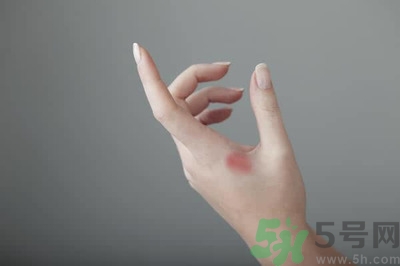 手被燙紅了怎么辦？手被燙了怎么止痛？