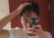 頭痛可以在額頭上拔火罐嗎？額頭上拔火罐有什么好處？