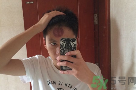 頭痛可以在額頭上拔火罐嗎？額頭上拔火罐有什么好處？