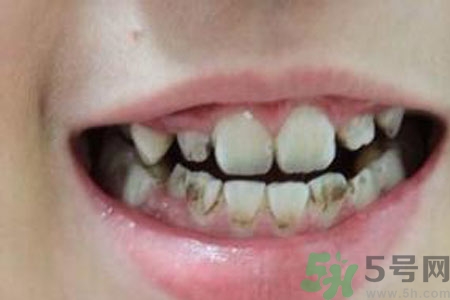 小孩牙齒發(fā)黑怎么回事？小孩牙齒發(fā)黑怎么辦？