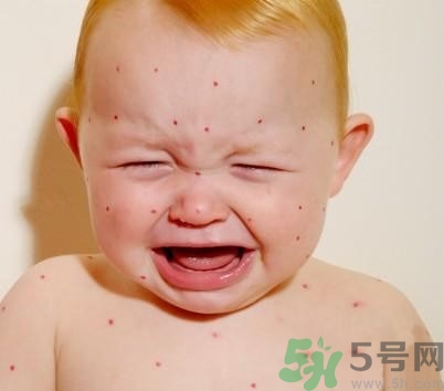 新生兒濕疹怎么引起的？新生兒濕疹如何處理？