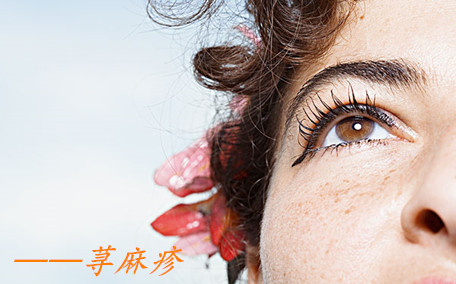 蕁麻疹能吃小龍蝦嗎 蕁麻疹能吃櫻桃嗎