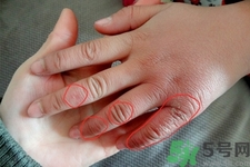 治療凍瘡用什么藥最好？凍瘡吃什么水果好？