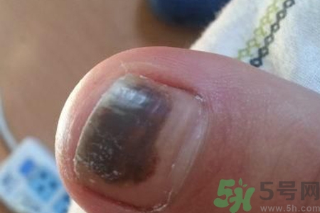 腳趾甲變黑是什么原因？腳趾甲變黑是怎么回事？