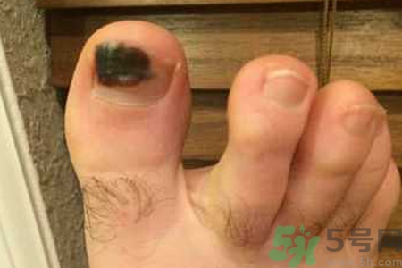 腳趾甲變黑是什么原因？腳趾甲變黑是怎么回事？