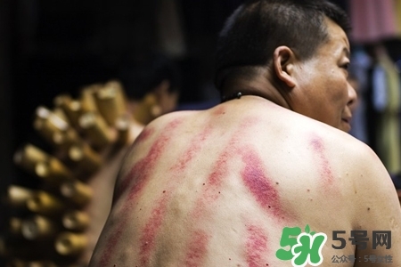背部刮痧后能拔火罐嗎？背部刮痧后拔火罐有什么好處？