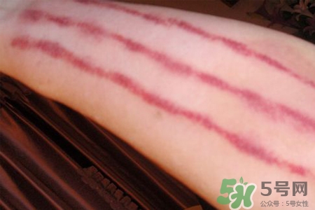 揪痧和刮痧哪個(gè)效果比較好？揪痧和刮痧的區(qū)別？