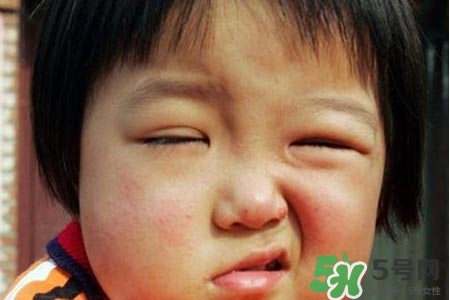 拔牙會(huì)導(dǎo)致面癱嗎?？拔牙為什么會(huì)導(dǎo)致面癱？