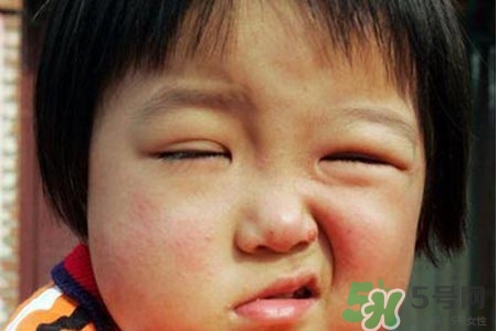 鼻炎會(huì)引起面癱嗎？鼻炎為什么會(huì)導(dǎo)致面癱？