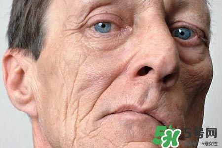 老年人為什么容易得面癱？老年人面癱原因有哪些？