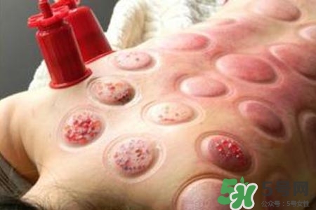 拔罐放血對(duì)身體好嗎？拔罐放血有什么好處？