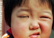 如何預防面癱復發(fā)？導致面癱的四大原因