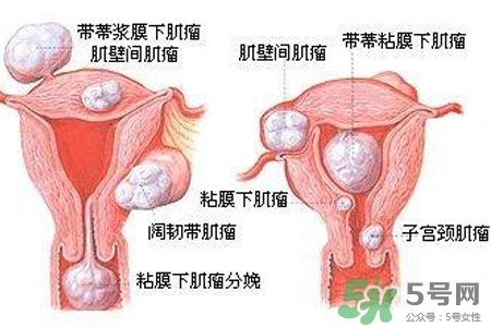子宮小會影響生育嗎？子宮小會導(dǎo)致不孕嗎？