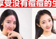 伊詩蘭頓祛痘怎么樣？伊詩蘭頓祛痘膏有用嗎？