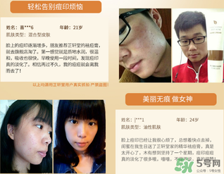 芷軒堂祛痘有效果嗎？芷軒堂祛痘印效果怎么樣？