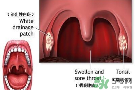 口含大蒜能治療咽炎嗎？巧用大蒜治療咽炎咳嗽