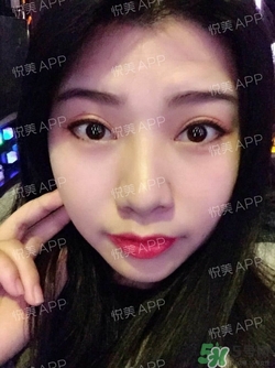 切開雙眼皮消腫過程圖_切開雙眼皮恢復過程圖