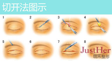 定點(diǎn)雙眼皮怎么做？定點(diǎn)雙眼皮需要拆線嗎？