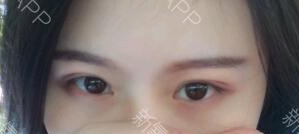 定點(diǎn)雙眼皮能保持多久？定點(diǎn)雙眼皮是永久的嗎？
