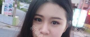 定點(diǎn)雙眼皮能保持多久？定點(diǎn)雙眼皮是永久的嗎？