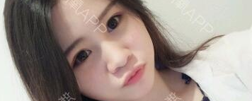 定點(diǎn)雙眼皮能保持多久？定點(diǎn)雙眼皮是永久的嗎？