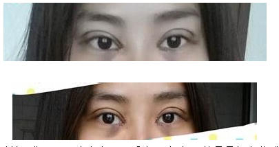 定點(diǎn)雙眼皮怎么做？定點(diǎn)雙眼皮需要拆線嗎？