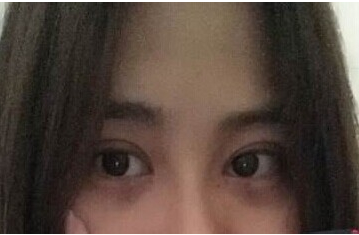 定點(diǎn)雙眼皮怎么做？定點(diǎn)雙眼皮需要拆線嗎？