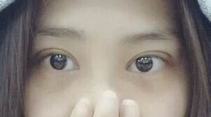 定點(diǎn)雙眼皮怎么做？定點(diǎn)雙眼皮需要拆線嗎？