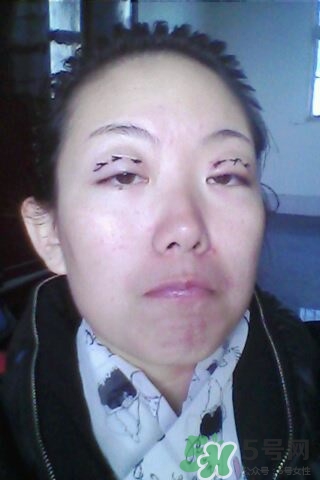 什么是定點(diǎn)雙眼皮？定點(diǎn)雙眼皮多少錢？