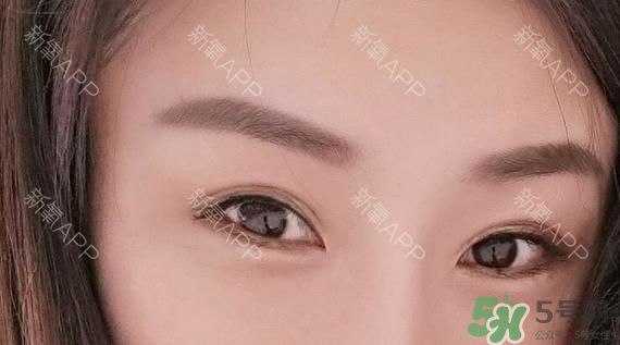 埋線雙眼皮能保持多久？埋線雙眼皮是永久嗎