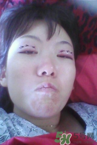 什么是定點(diǎn)雙眼皮？定點(diǎn)雙眼皮多少錢？