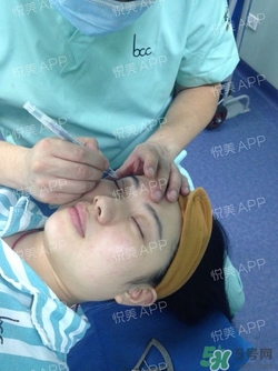 切開雙眼皮消腫過程圖_切開雙眼皮恢復過程圖