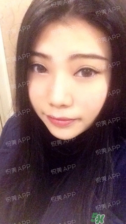 切開雙眼皮消腫過程圖_切開雙眼皮恢復過程圖