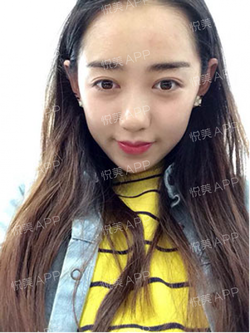 三點雙眼皮恢復過程圖_韓式三點雙眼皮多久恢復自然
