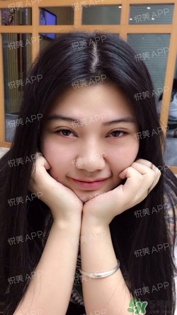 切開雙眼皮消腫過程圖_切開雙眼皮恢復過程圖