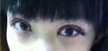 韓式三點(diǎn)雙眼皮是永久嗎？三點(diǎn)雙眼皮能保持多久？