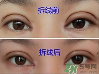 定點(diǎn)雙眼皮恢復(fù)過程圖_定點(diǎn)雙眼皮要多久恢復(fù)