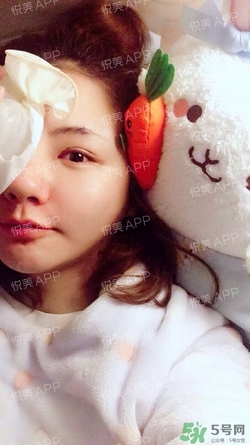定點雙眼皮恢復過程圖_定點雙眼皮要多久恢復