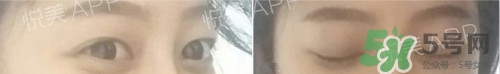 埋線雙眼皮多久恢復(fù)自然？埋線雙眼皮多久能恢復(fù)