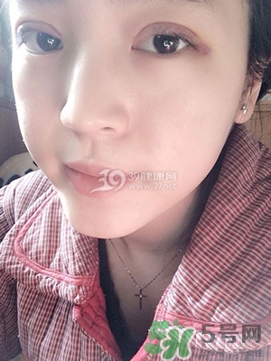 什么是定點(diǎn)雙眼皮？定點(diǎn)雙眼皮多少錢？